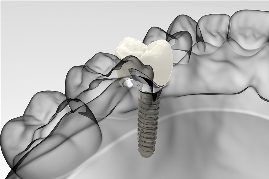 Dental Implants Devon
