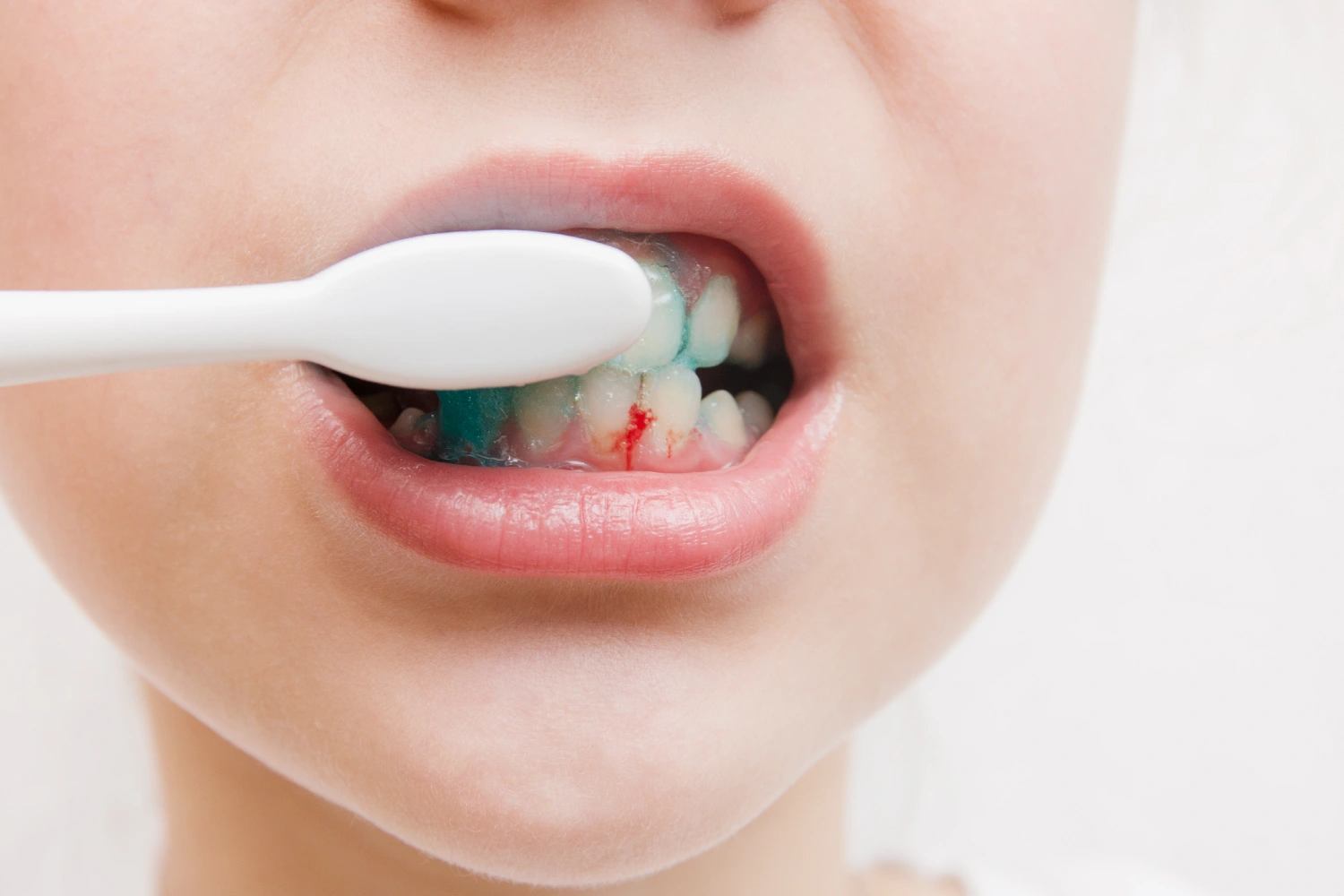 Is It Normal for Gums to Bleed While Brushing Common Causes & Solutions