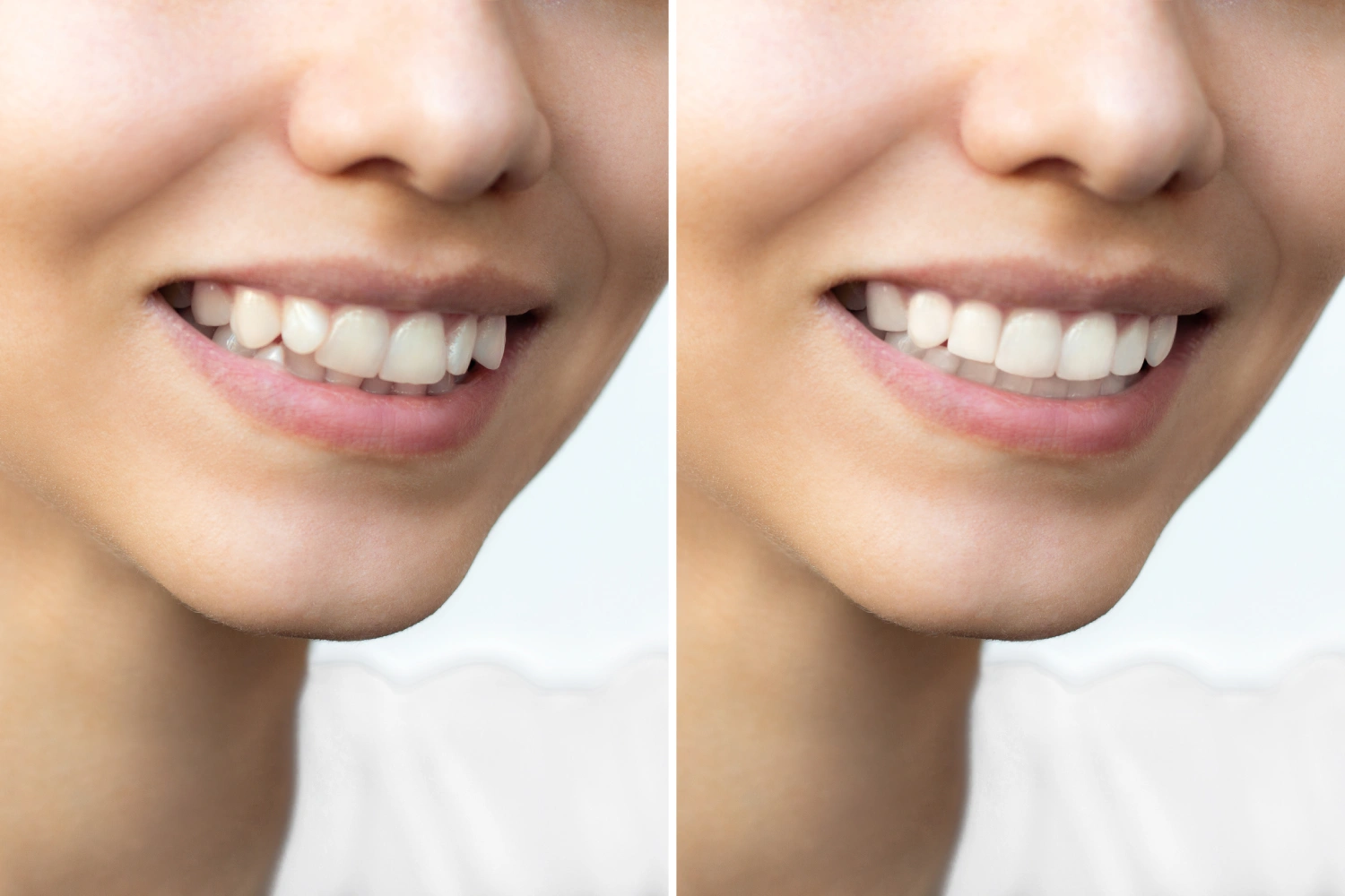Is Teeth Whitening Right for You