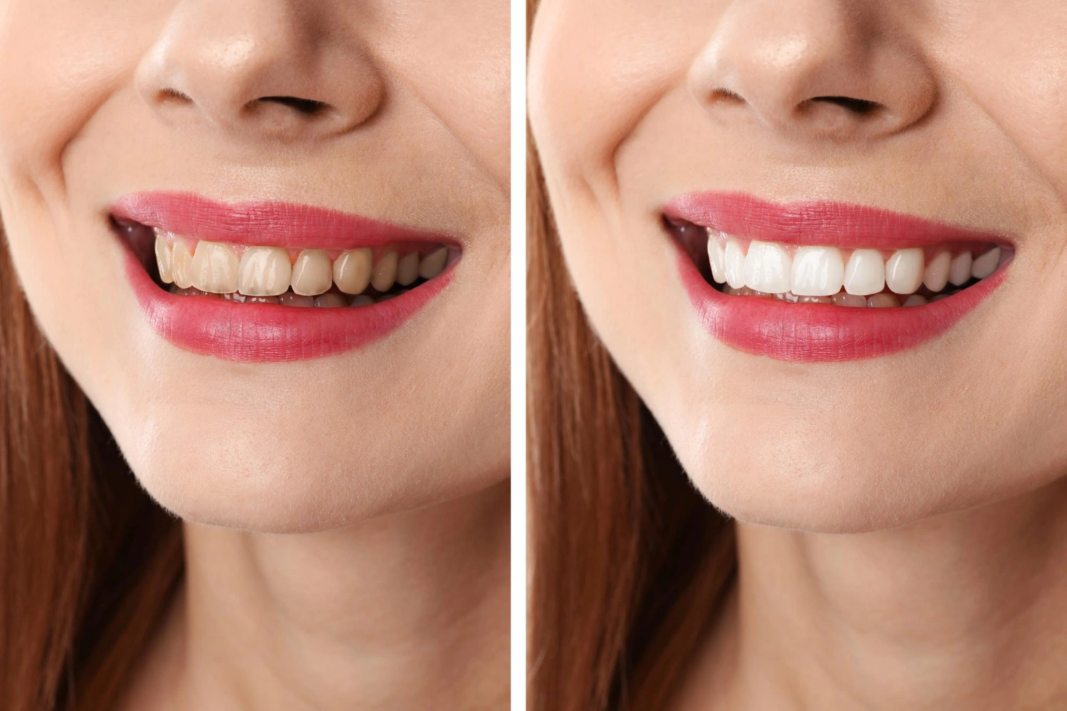 Teeth Whitening in Devon What to Expect Before, During, and After