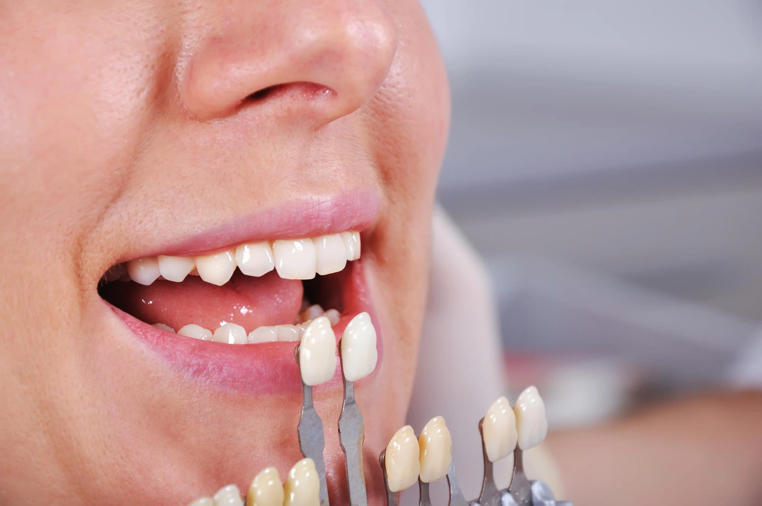 How Long Do Veneers Last