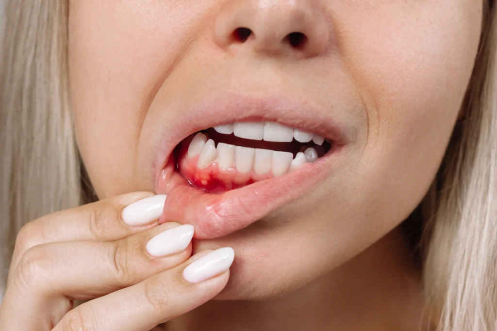 Is It Normal for Gums to Bleed While Brushing Common Causes & Solutions - Image