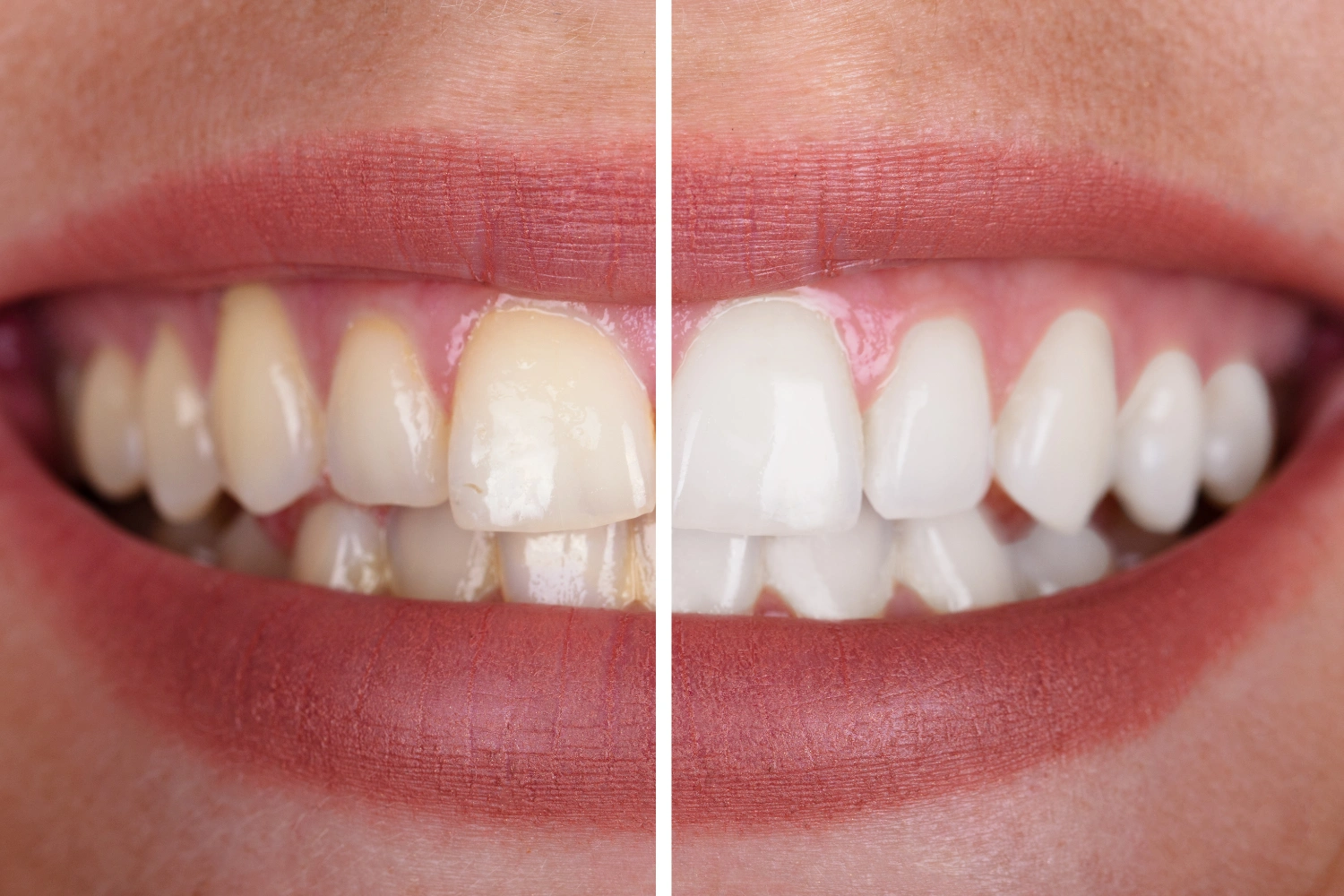 Teeth Whitening in Devon What to Expect Before, During, and After - Image