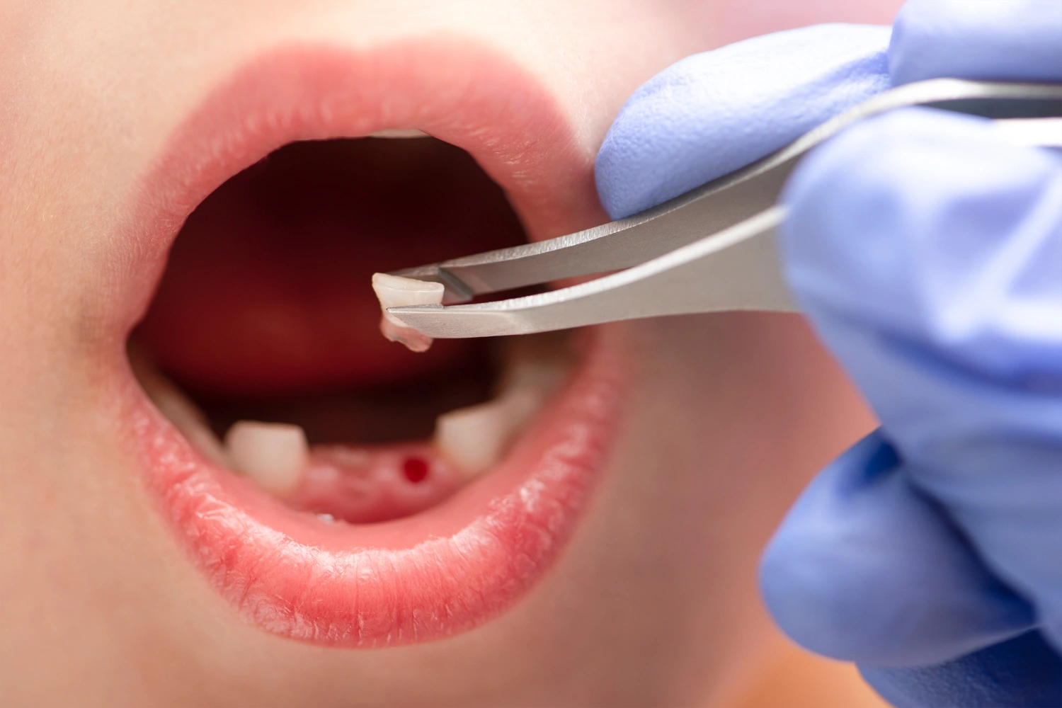 What Should I Do If I Knock Out a Tooth Devon Dental Centre - Image